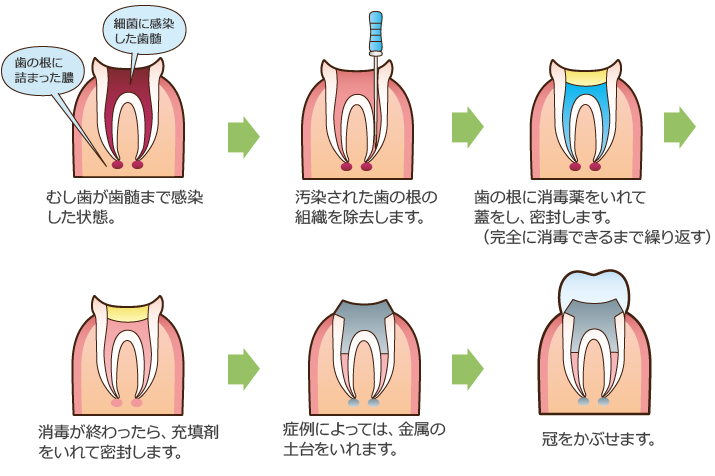 根管治療の流れ